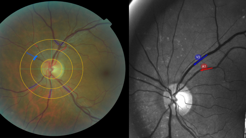 Bei einer Augenuntersuchung können der Durchmesser kleinster Blutgefäße (links) und die Erweiterung der Gefäße als Reaktion auf Lichtimpulse (rechts) gemessen werden. Beide sind bei Menschen mit Long Covid verändert. Abb: Abteilung für Nephrologie / TUM